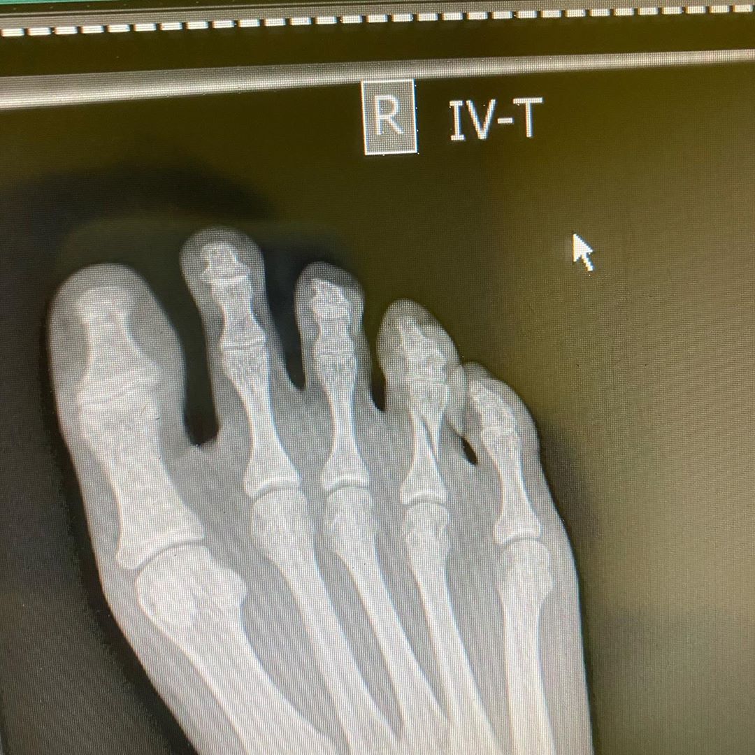 Дочка Олі Полякової з гіпсом на нозі вперше показала обличчя бойфренда