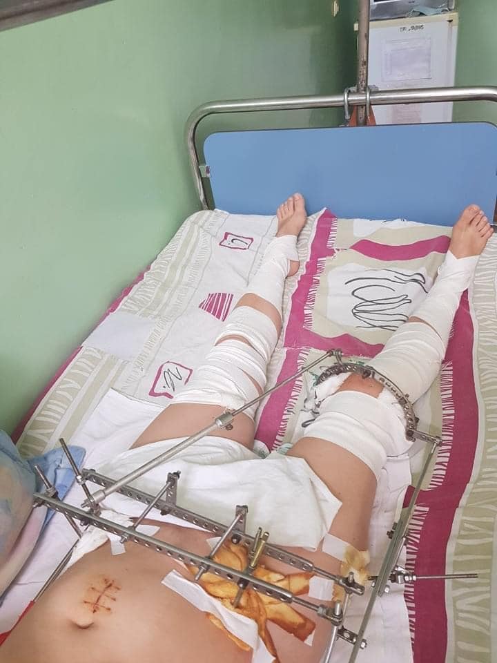 Дівчина випала з вікна 4 поверху: потрібна допомога