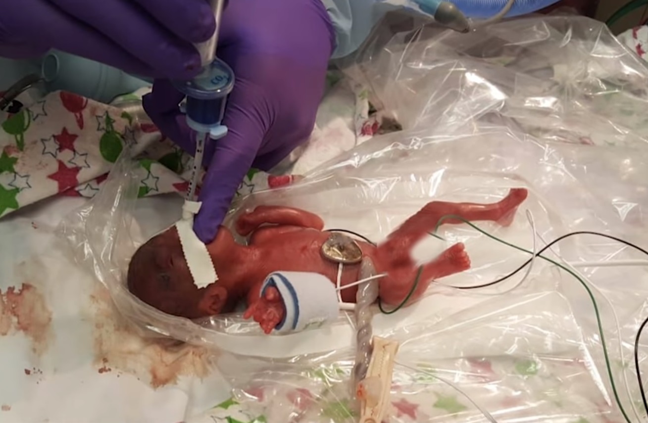 Настоящий боец: девочка родилась с весом 245 граммов и выжила (видео)