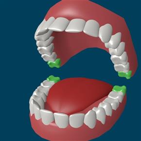 Что может быть, если не удалять зубы мудрости?