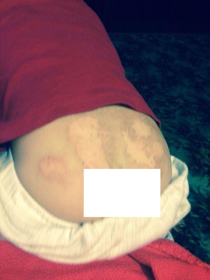 Під Запоріжжям медсестра дитсадка прописала дитині мазь для котів: наслідки лікували довго