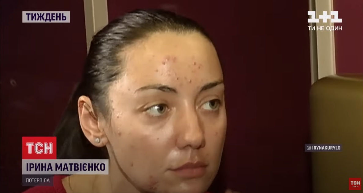 Украинка рассказала, как поход к косметологу лишил ее здоровья и квартиры