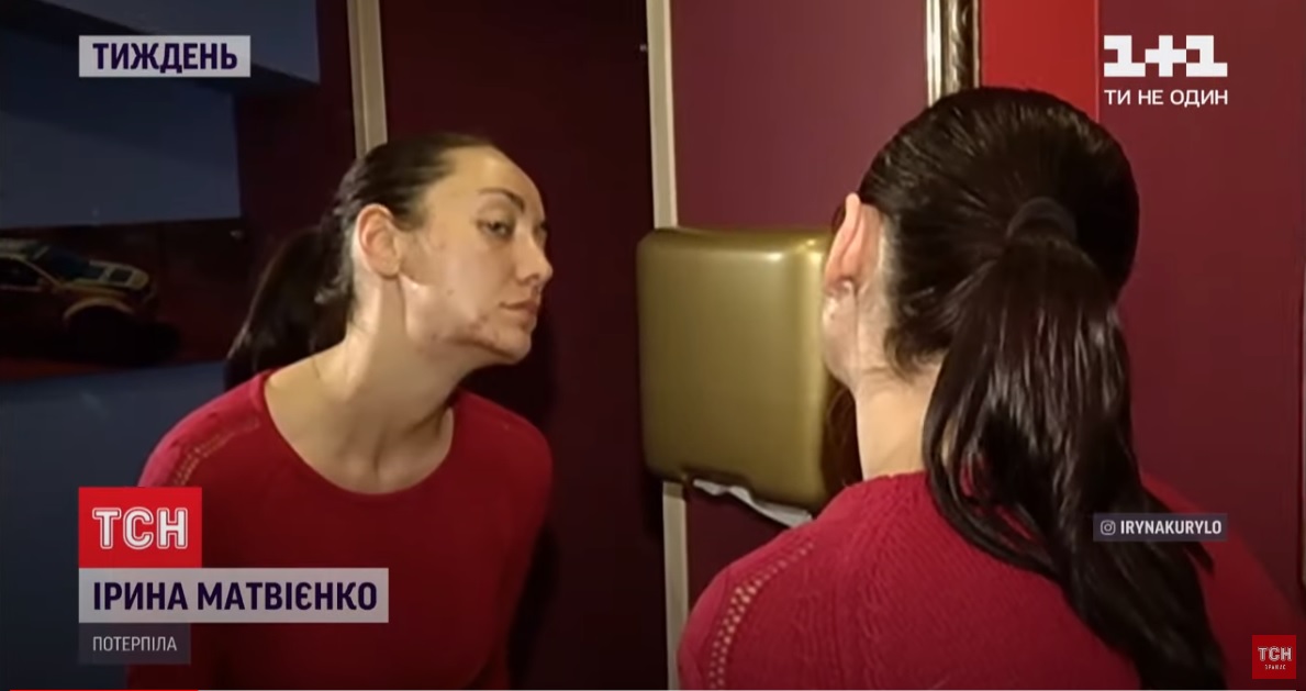 Украинка рассказала, как поход к косметологу лишил ее здоровья и квартиры