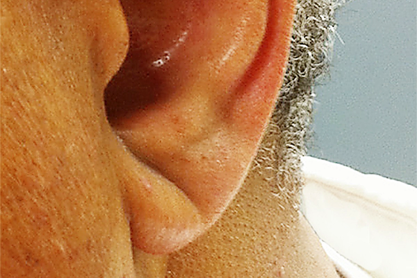 "Знак" на ушах может предупредить о сердечном приступе: как он выглядит