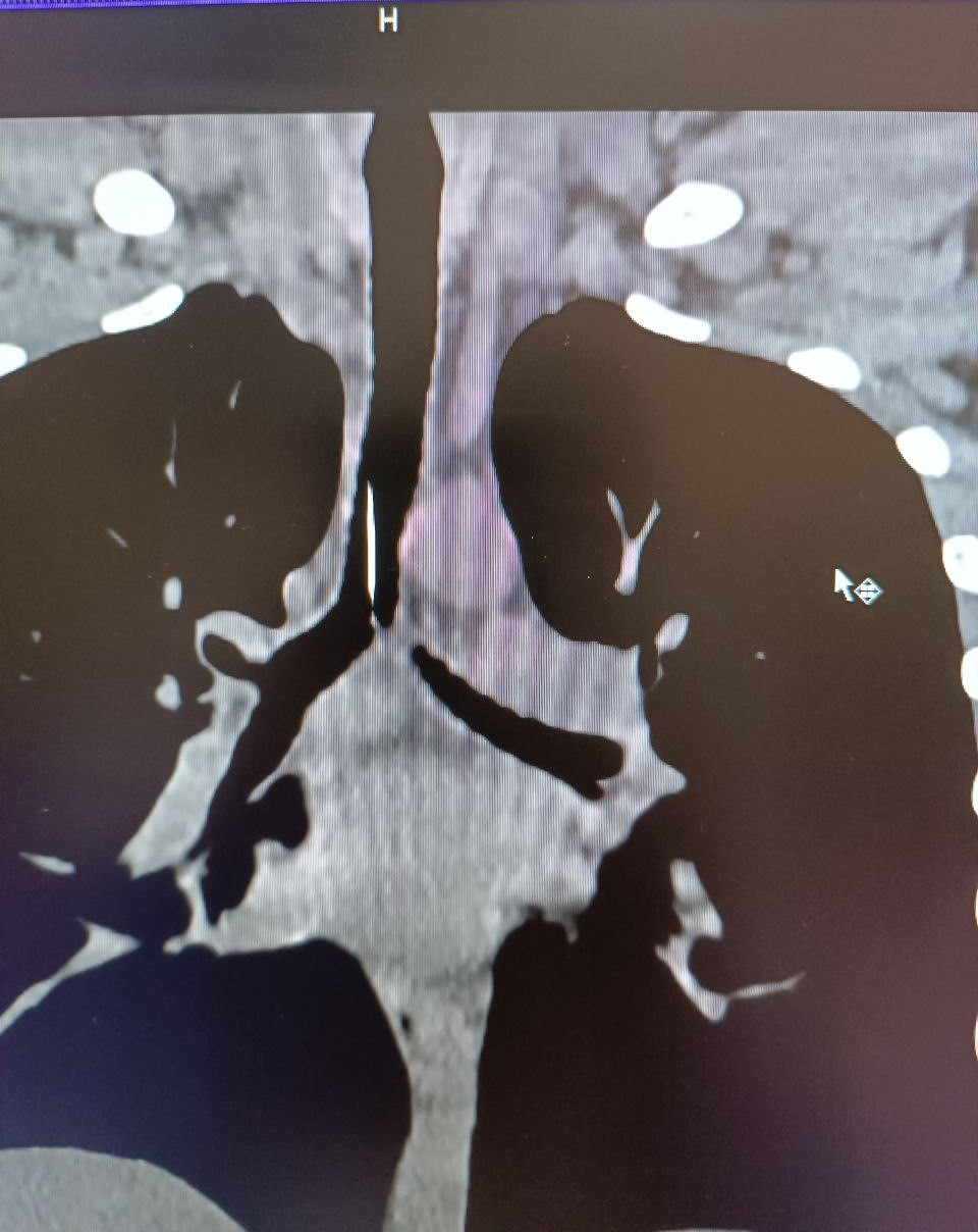 Застряла прямо в трахее: в Одесской области подросток случайно вдохнул шпильку