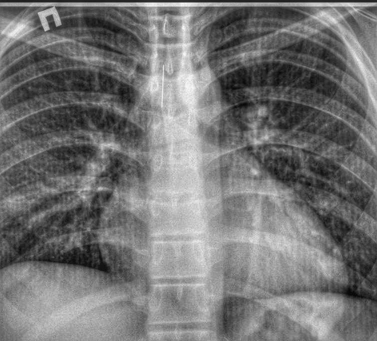 Застряла прямо в трахее: в Одесской области подросток случайно вдохнул шпильку