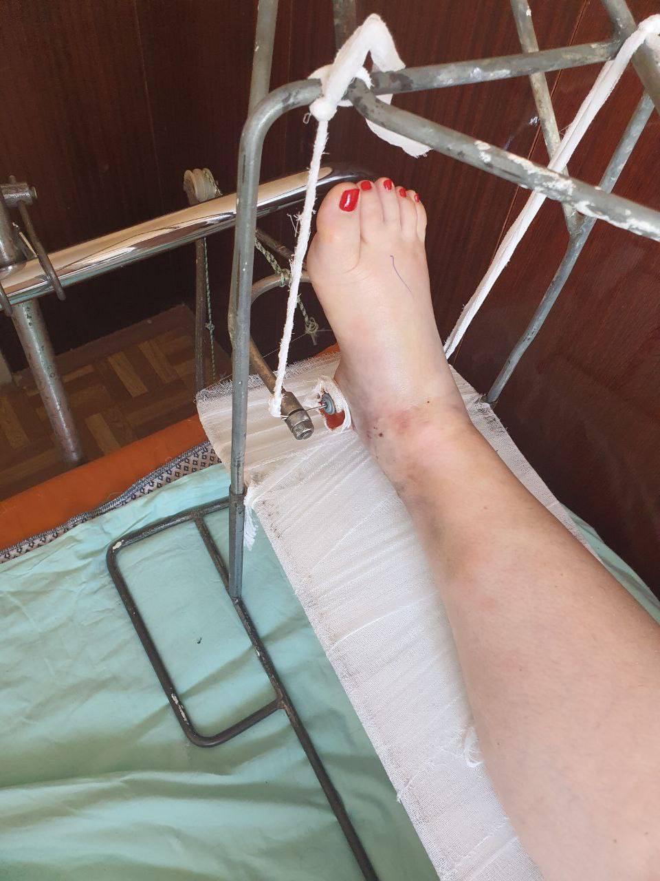 Двигаться почти не могу: Руслана Писанка рассказала о своем состоянии после падения на сцене