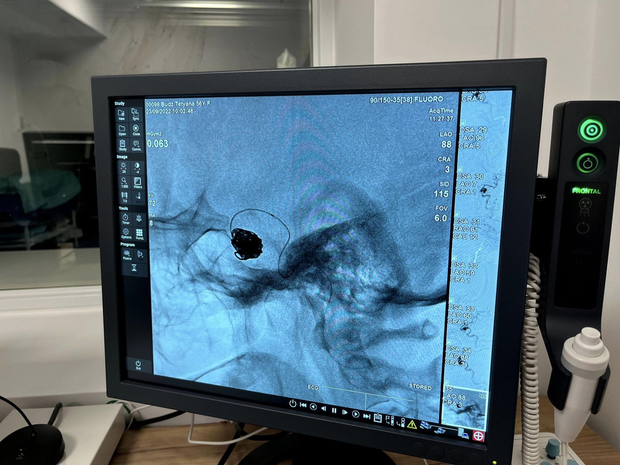 Ни одного разреза: украинские медики спасли жизнь женщине с огромной аневризмой