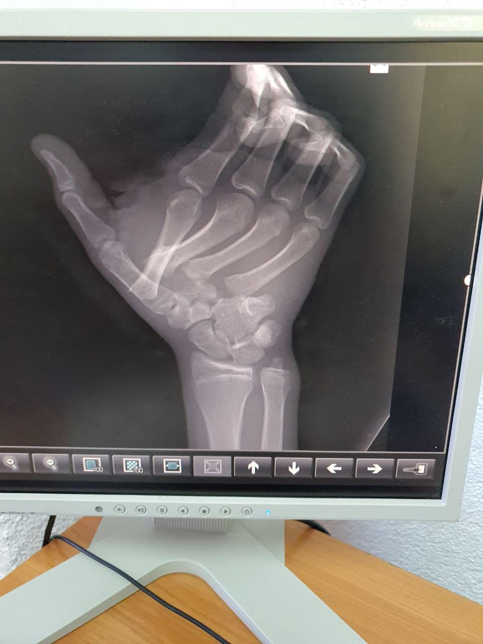 Впервые работали с такой сложной травмой: во Львове врачи чудом спасли парню руку