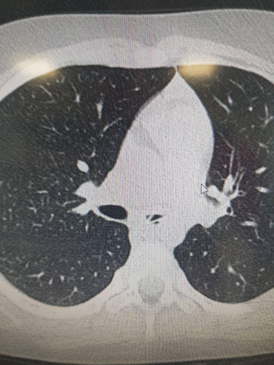 В Украине в теле ребенка обнаружили ложку, которая находилась там несколько месяцев (фото)