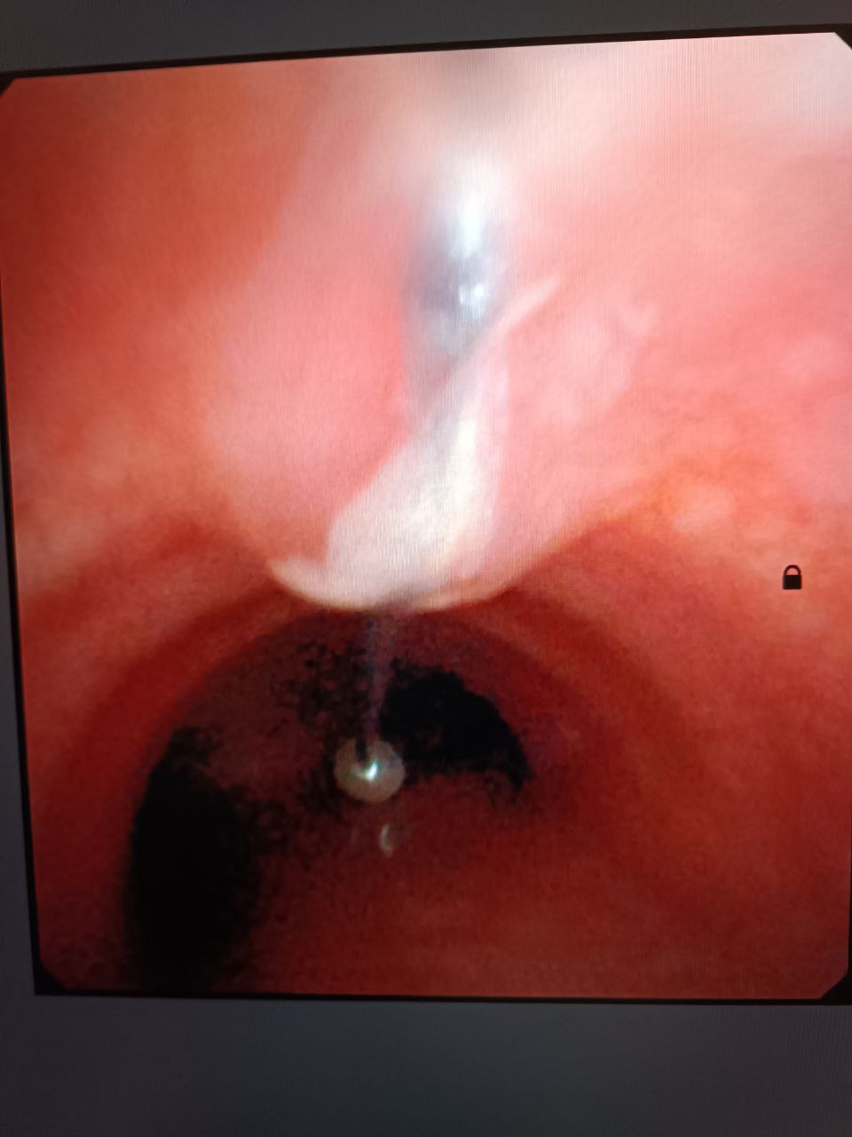 Застряла прямо в трахее: в Одесской области подросток случайно вдохнул шпильку