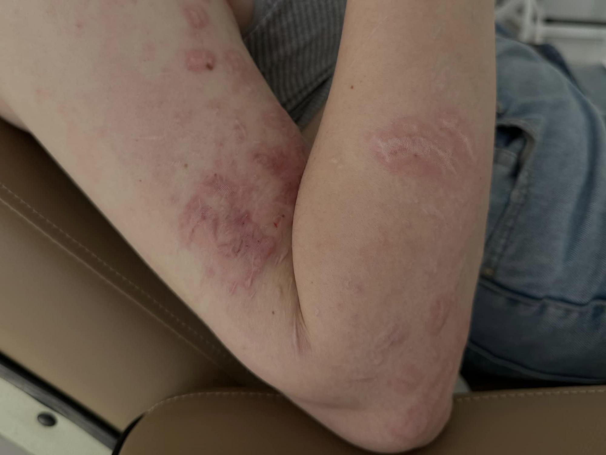 Ракета понівечила обличчя: медики "повертають красу" 20-річній дівчині перед весіллям