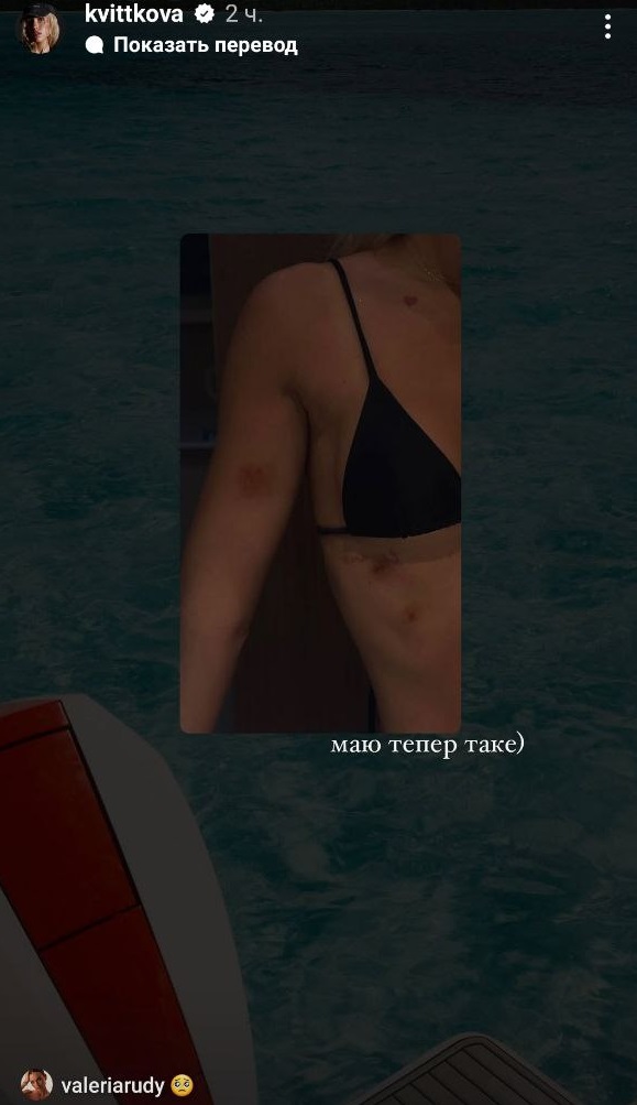 Даша Квіткова отримала травму під час шикарного відпочинку на яхті в Домінікані: фото наслідків