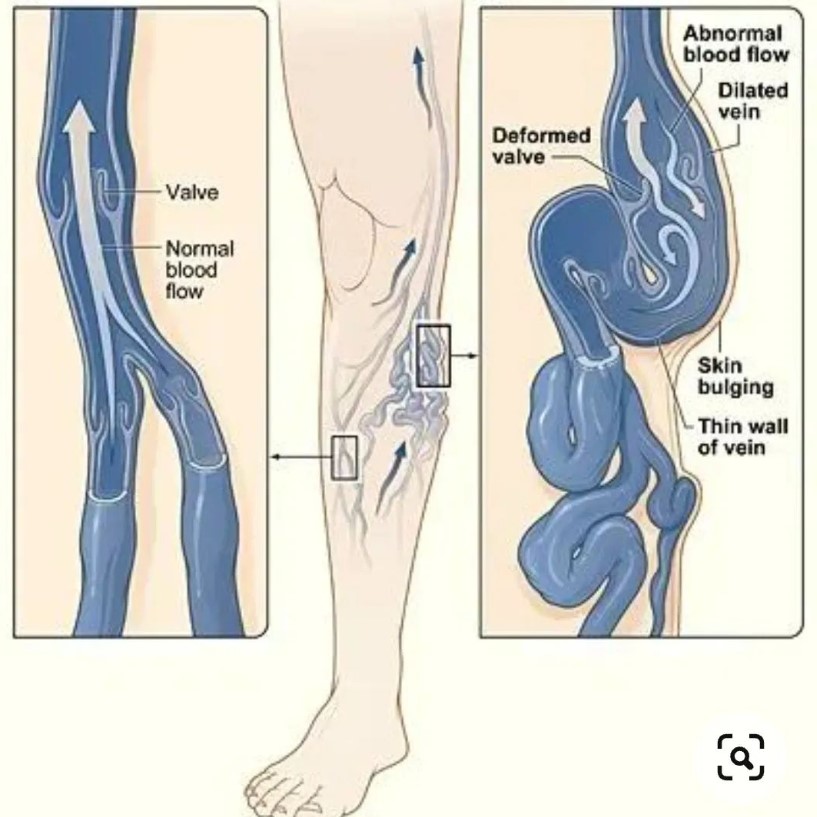 Недостаток или бомба замедленного действия? Чем на самом деле грозит варикоз