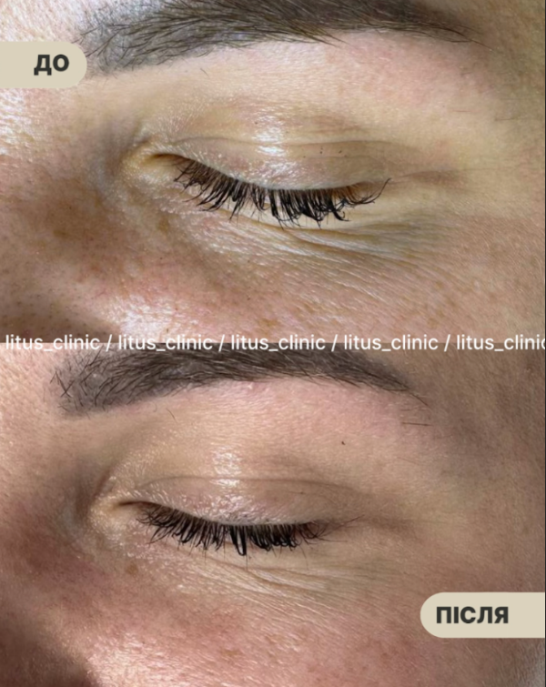 Ірина Літус: Exoxe, HP Cell Vitaran та Iuse Skin Booster HA20 – нова ера в профілактиці старіння шкіри