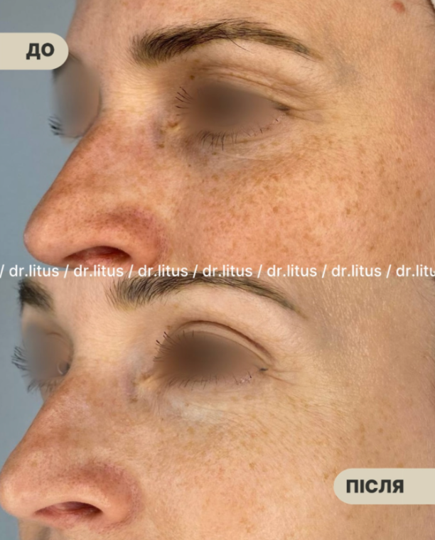 Ірина Літус: Exoxe, HP Cell Vitaran та Iuse Skin Booster HA20 – нова ера в профілактиці старіння шкіри