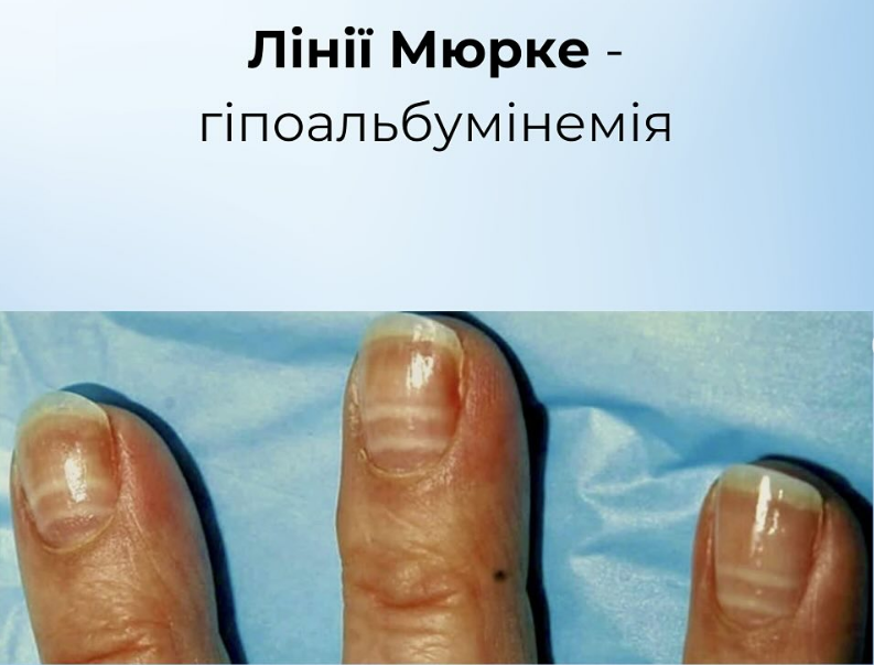 На проблему вкажуть нігті: як розпізнати харчові дефіцити й повернути собі здоров'я