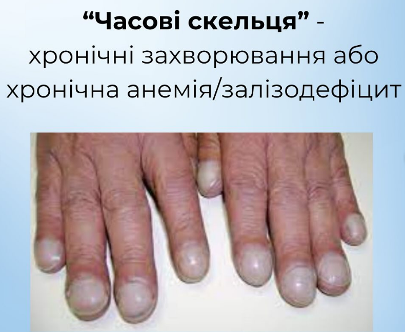 На проблему вкажуть нігті: як розпізнати харчові дефіцити й повернути собі здоров'я
