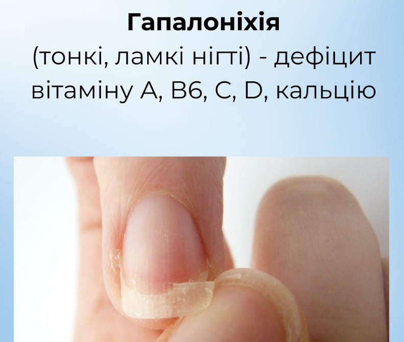 На проблему вкажуть нігті: як розпізнати харчові дефіцити й повернути собі здоров'я