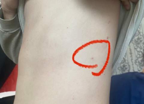 Боєць ЗСУ три тижні воював зі зламаним хребтом. Лікарі були шоковані