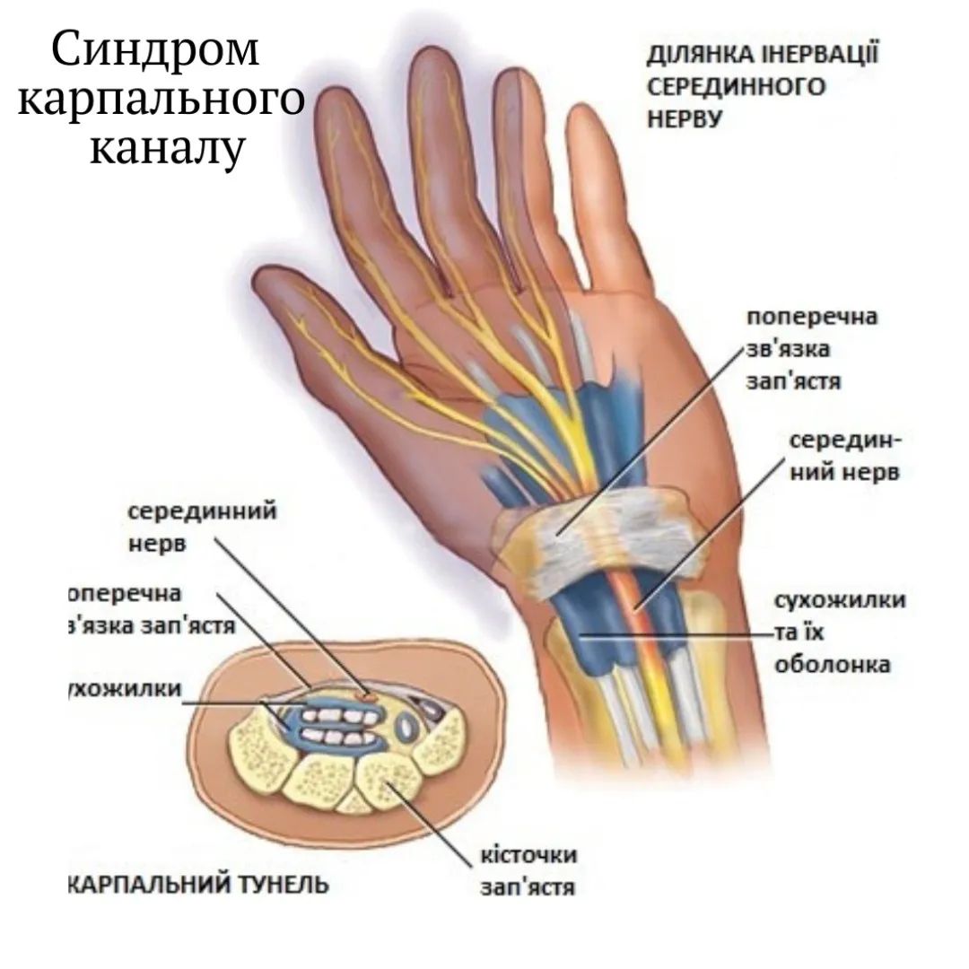 Лучезапястный сустав лечение. Карпальный туннельный синдром кисти. Туннельный карпальный синдром руки. Синдром карпального канала запястья. Карпальный канал лучезапястного сустава.