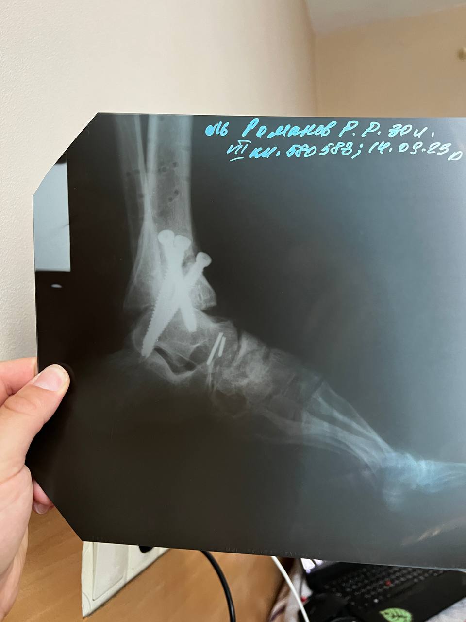 "Росія хоче, щоб ми всі покинули рідну країну і забули свою історію". Доброволець ЗСУ дивом вижив після поранення