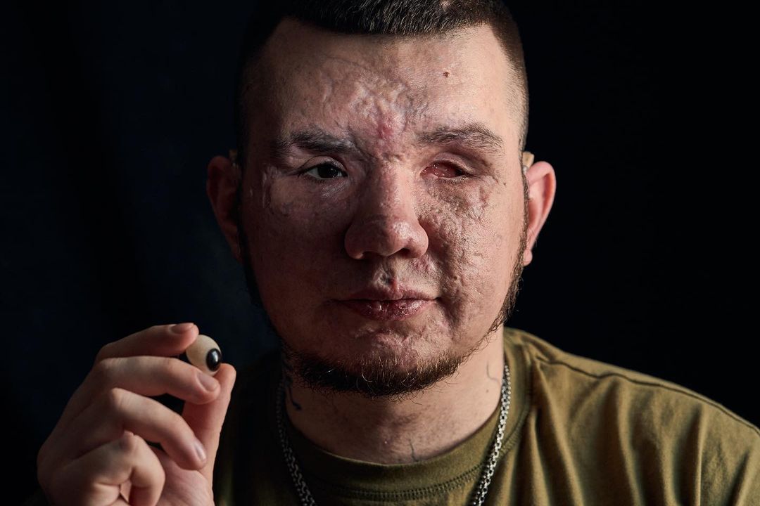 "Наречена підтримує з перших днів". Чуттєва історія Влада, який втратив очі, захищаючи Україну
