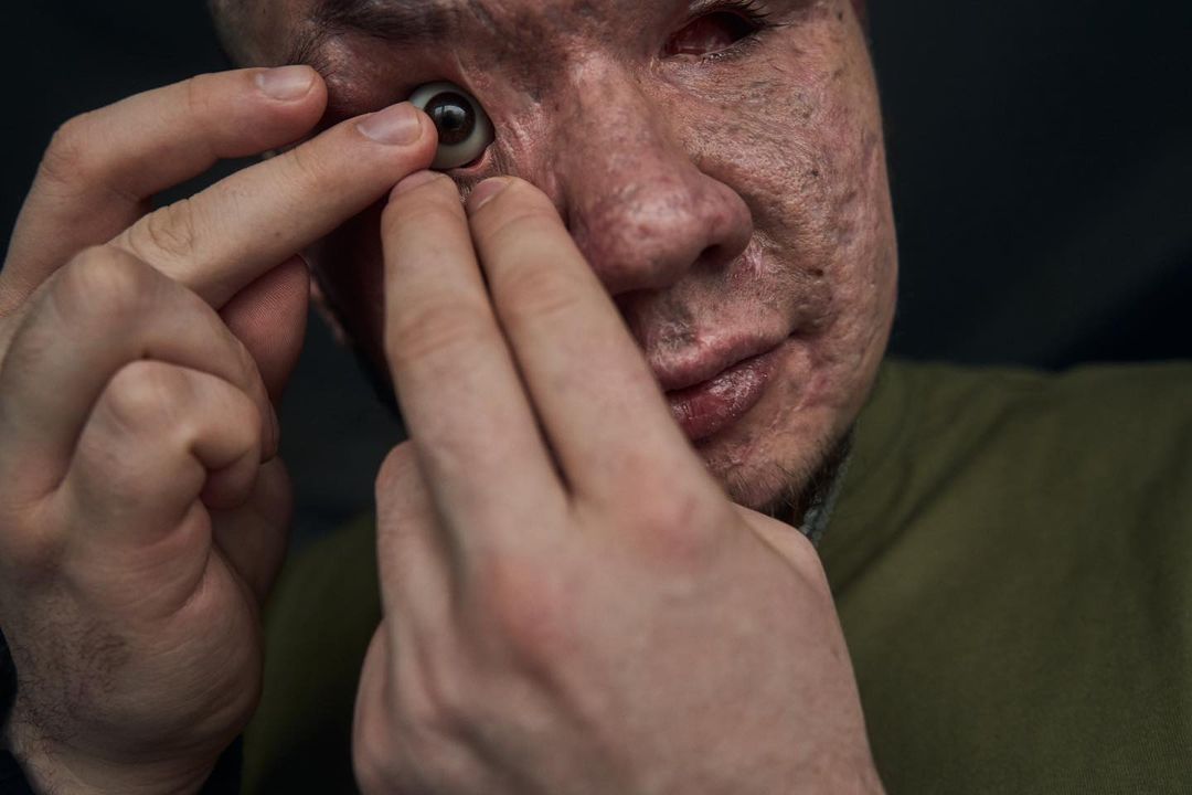 "Наречена підтримує з перших днів". Чуттєва історія Влада, який втратив очі, захищаючи Україну
