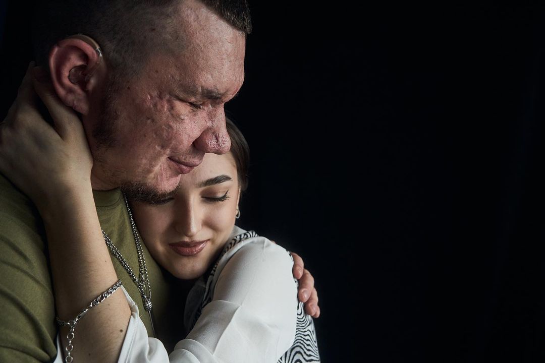 "Наречена підтримує з перших днів". Чуттєва історія Влада, який втратив очі, захищаючи Україну