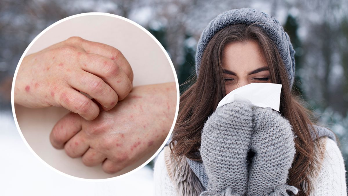 Аллергия на холод – такое бывает? Аллерголог рассказала, почему на морозе возникает сыпь и зуд
