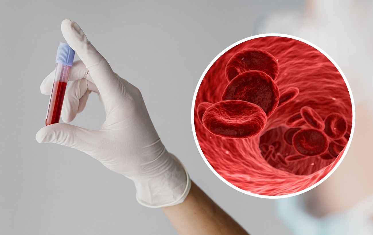 Лечение анемии: как избавиться от малокровия - Ameda