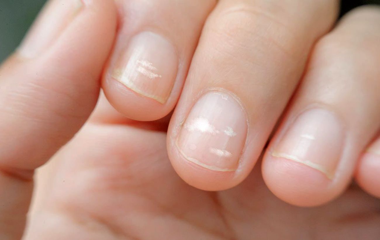 Почему появляются белые пятна на ногтях? Ответил врач. Спорт-Экспресс