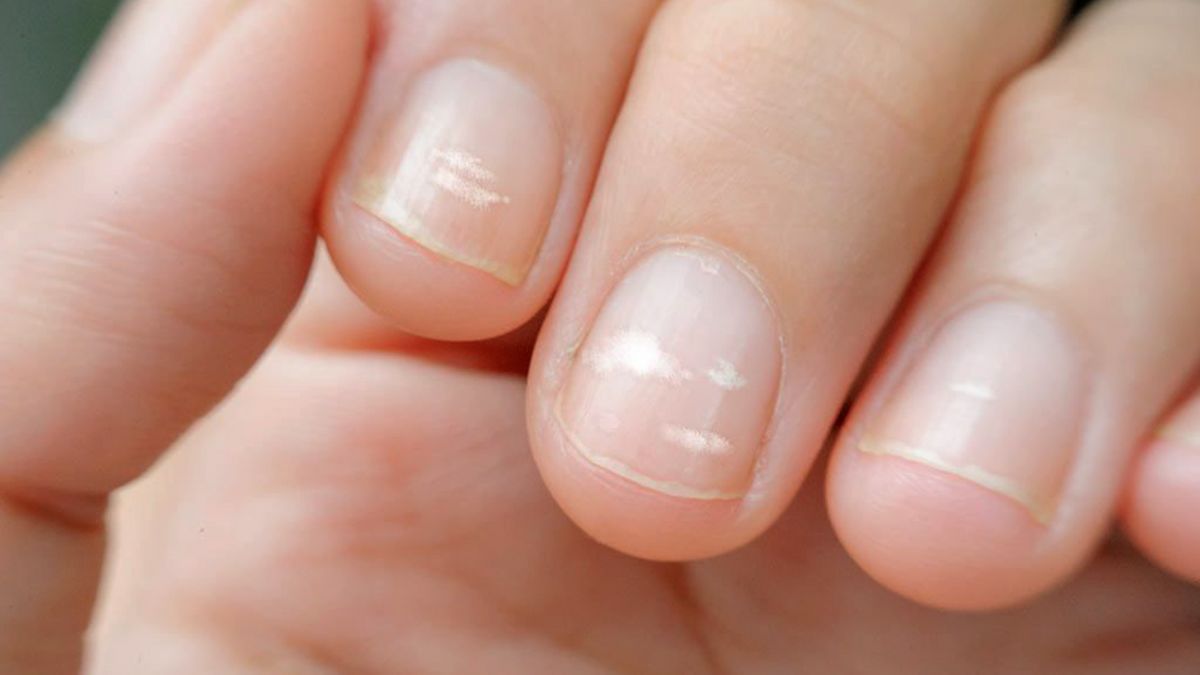 Белые пятна на ногтях: причины и лечение у взрослых и детей | эталон62.рф